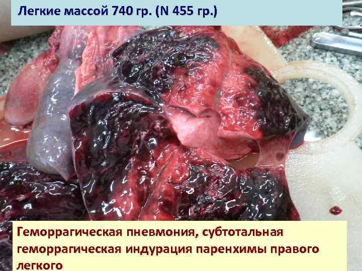 Легкие массой 740 гр. (N 455 гр. ) Геморрагическая пневмония, субтотальная геморрагическая индурация паренхимы