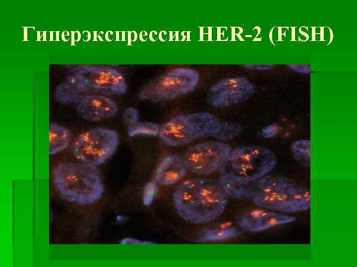 Гиперэкспрессия HER-2 (FISH) 