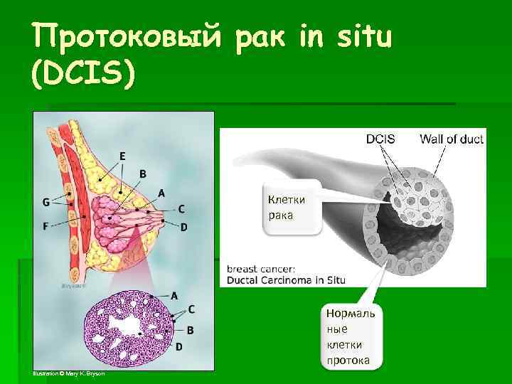 Протоковая карцинома in situ молочной