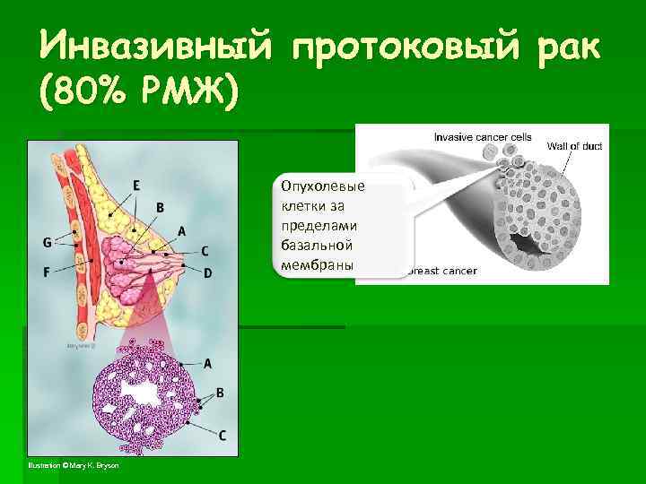 Инвазивный протоковый рак (80% РМЖ) Опухолевые клетки за пределами базальной мембраны 34 Illustration ©