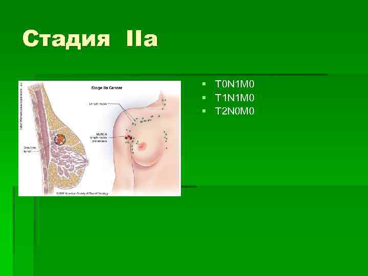 Стадия IIa § § § T 0 N 1 M 0 T 1 N