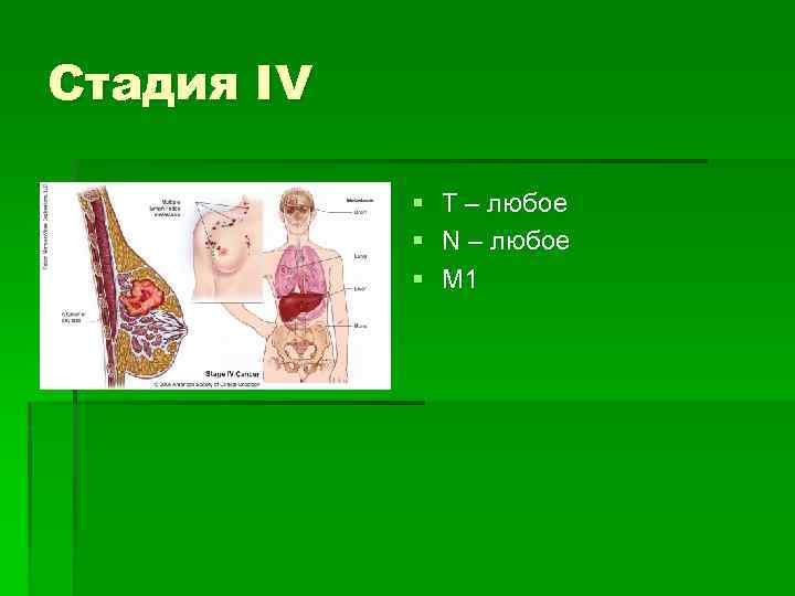 Стадия IV § § § Т – любое N – любое М 1 