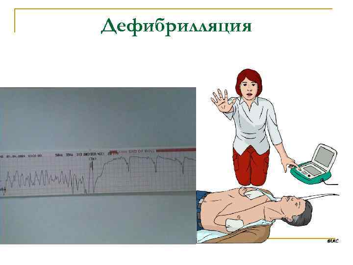 Дефибрилляция 
