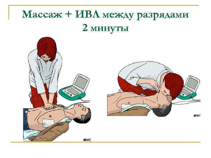 Массаж + ИВЛ между разрядами 2 минуты 
