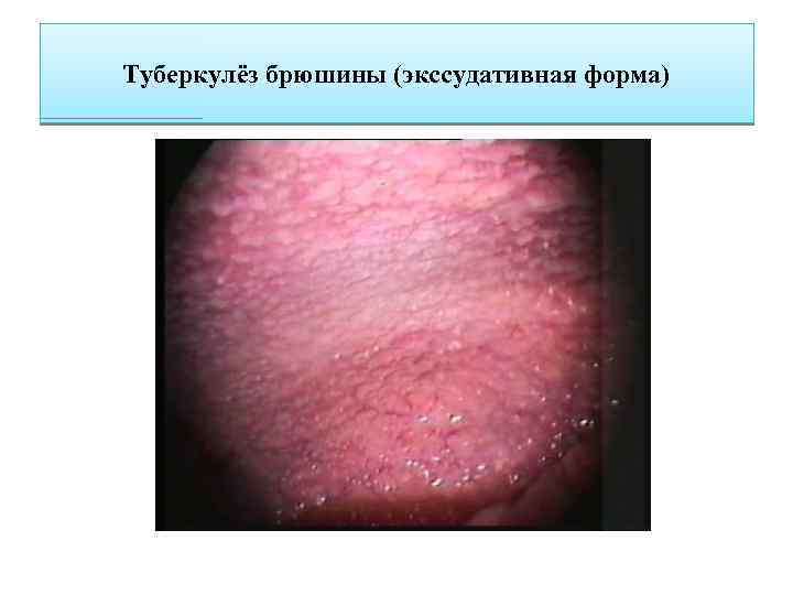 Туберкулёз брюшины (экссудативная форма) 