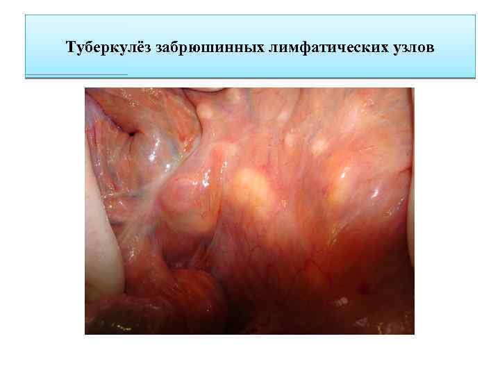 Туберкулёз забрюшинных лимфатических узлов 