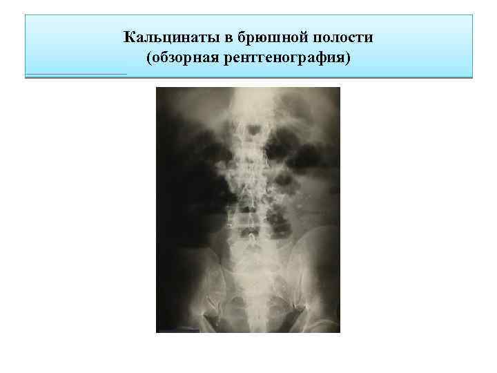 Кальцинаты в брюшной полости (обзорная рентгенография) 