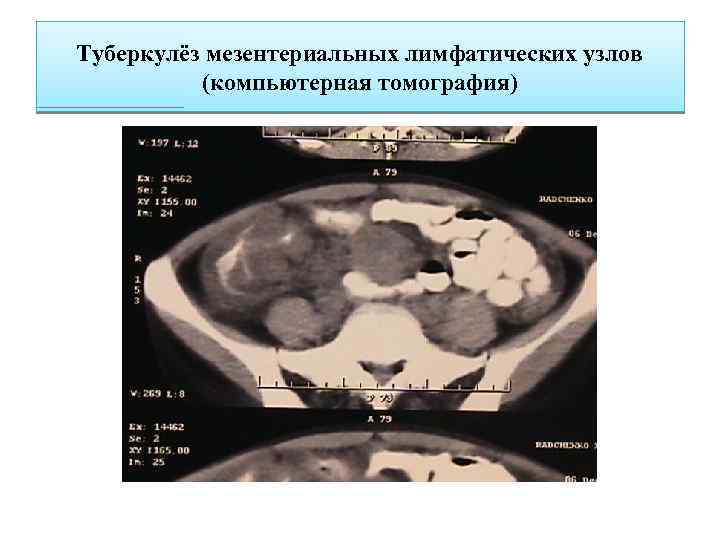 Туберкулёз мезентериальных лимфатических узлов (компьютерная томография) 