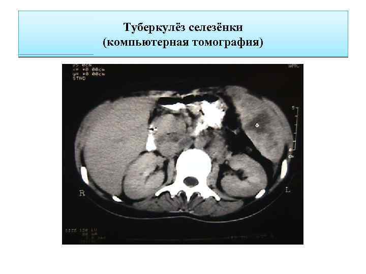 Туберкулёз селезёнки (компьютерная томография) 
