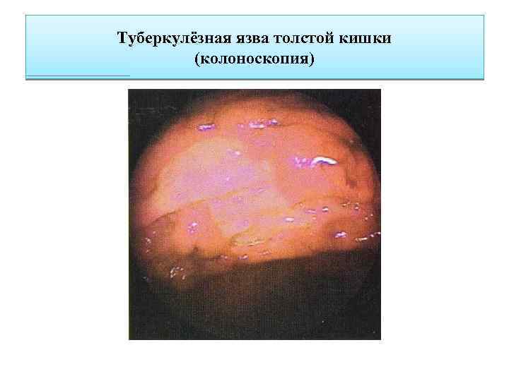 Туберкулёзная язва толстой кишки (колоноскопия) 