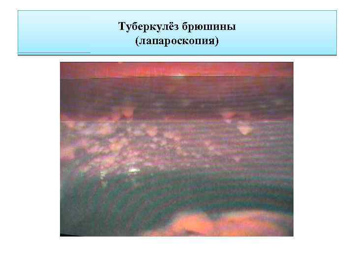 Туберкулёз брюшины (лапароскопия) 