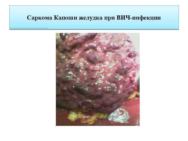 Саркома Капоши желудка при ВИЧ-инфекции 