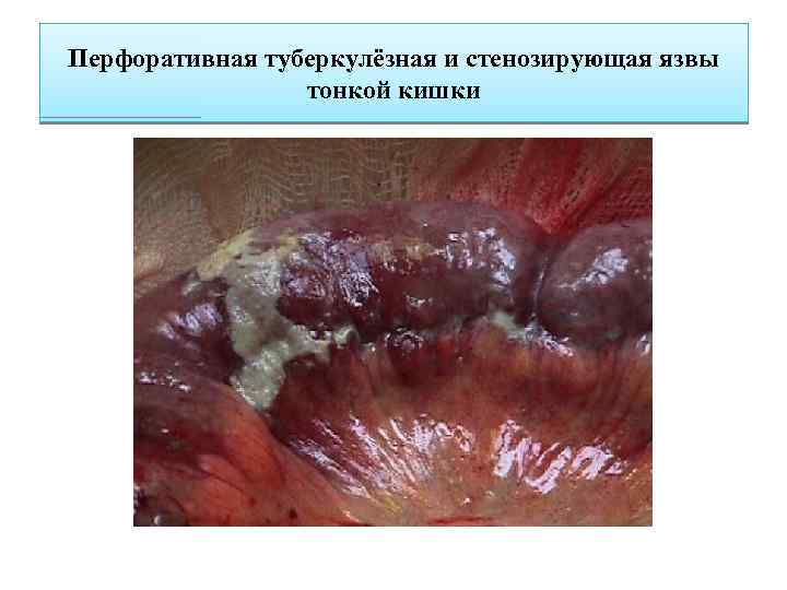 Перфоративная туберкулёзная и стенозирующая язвы тонкой кишки 