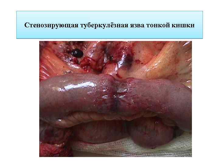 Стенозирующая туберкулёзная язва тонкой кишки 