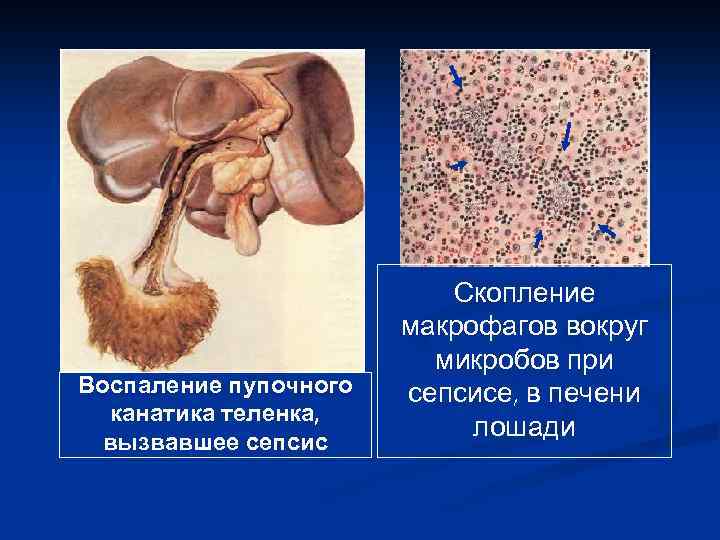 Воспаление пупочного канатика теленка, вызвавшее сепсис Скопление макрофагов вокруг микробов при сепсисе, в печени