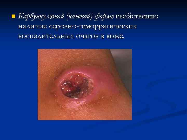 n Карбункулезной (кожной) форме свойственно наличие серозно геморрагических воспалительных очагов в коже. 