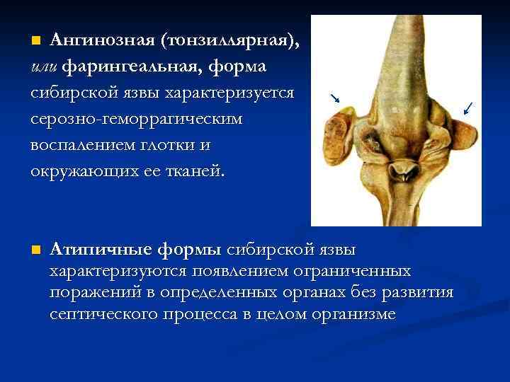 Ангинозная (тонзиллярная), или фарингеальная, форма сибирской язвы характеризуется серозно-геморрагическим воспалением глотки и окружающих ее