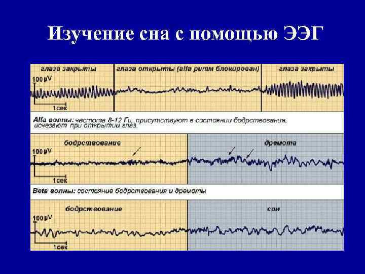 Изучение сна с помощью ЭЭГ 