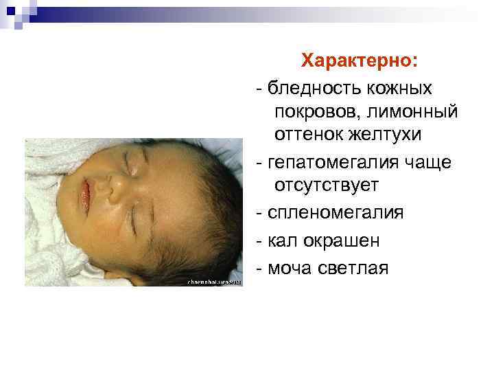 Характерно: - бледность кожных покровов, лимонный оттенок желтухи - гепатомегалия чаще отсутствует - спленомегалия