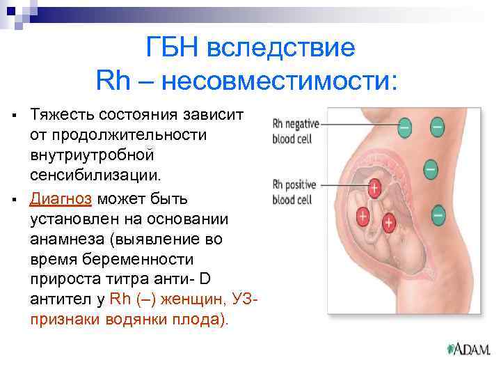 ГБН вследствие Rh – несовместимости: § § Тяжесть состояния зависит от продолжительности внутриутробной сенсибилизации.