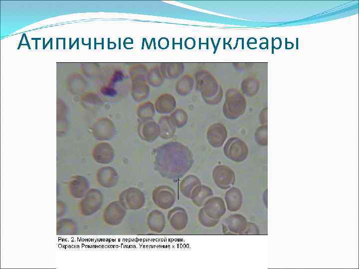 Атипичные мононуклеары 