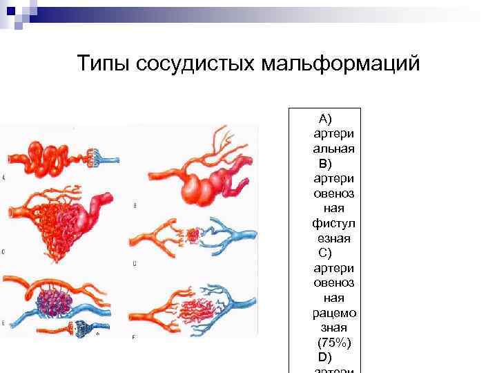 Типы сосудистых мальформаций А) артери альная В) артери овеноз ная фистул езная С) артери