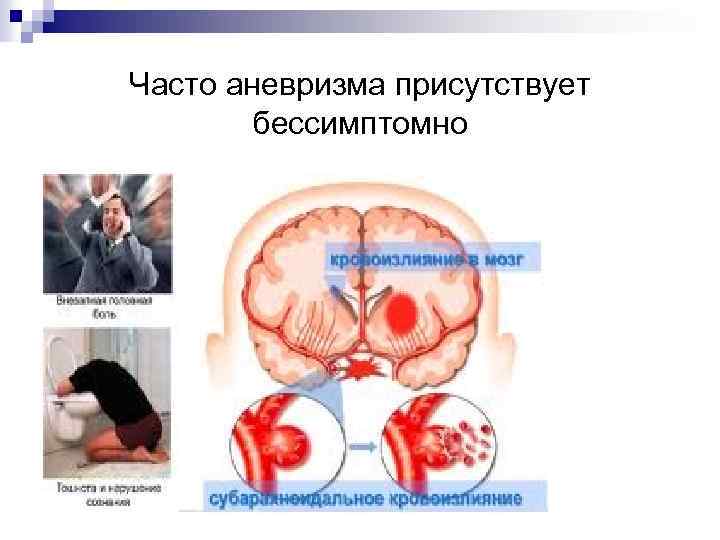 Часто аневризма присутствует бессимптомно 