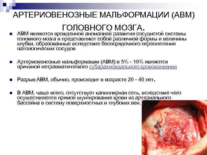 АРТЕРИОВЕНОЗНЫЕ МАЛЬФОРМАЦИИ (АВМ) ГОЛОВНОГО МОЗГА. n АВМ являются врожденной аномалией развития сосудистой системы головного