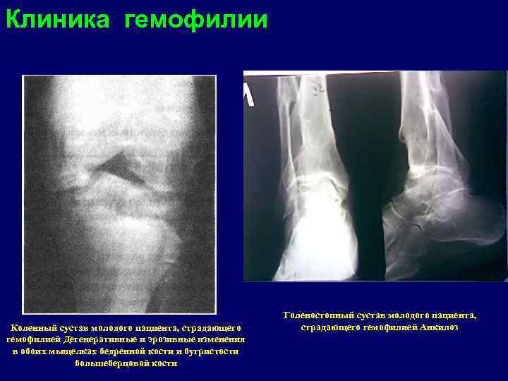 Клиника гемофилии Коленный сустав молодого пациента, страдающего гемофилией Дегенеративные и эрозивные изменения в обоих