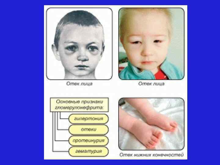 Отечный синдром характерен для. Симптомы заболевания гломерулонефрит у детей. Гломерулонефрит отечный синдром. Гломерулонефрит у детей симптоматика. Острый гломерулонефрит отеки.