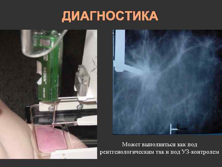 ДИАГНОСТИКА Может выполняться как под рентгенологическим так и под УЗ-контролем 