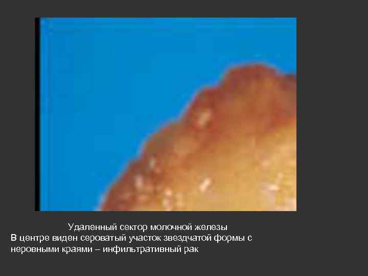 Удаленный сектор молочной железы В центре виден сероватый участок звездчатой формы с неровными краями