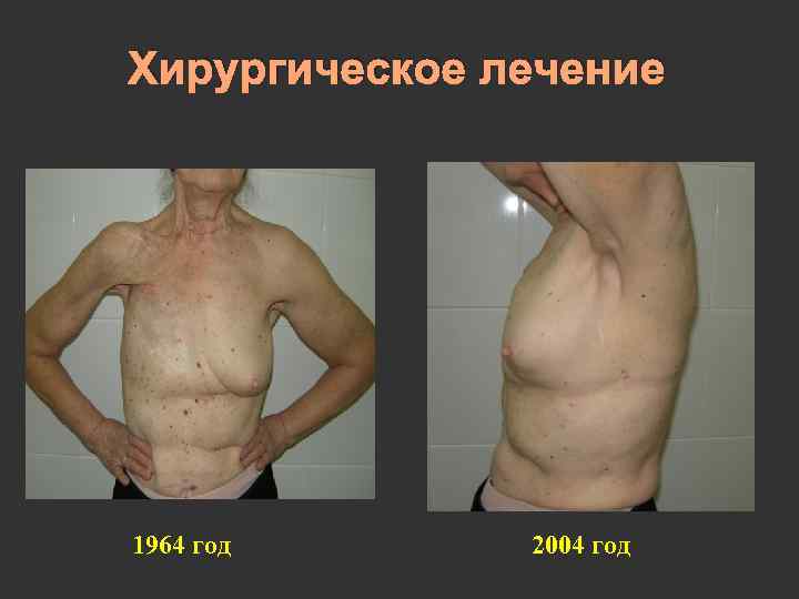 Хирургическое лечение 1964 год 2004 год 