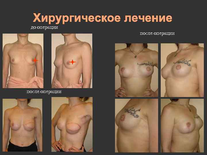 Хирургическое лечение до операции после операции 