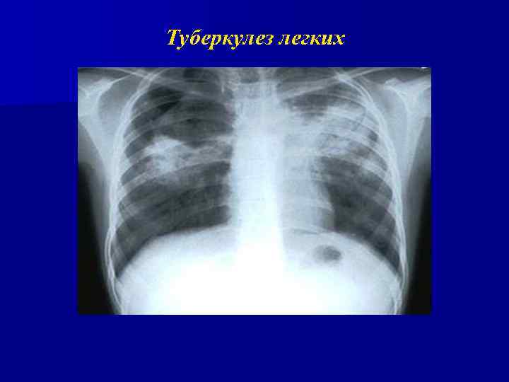 Туберкулез легких 