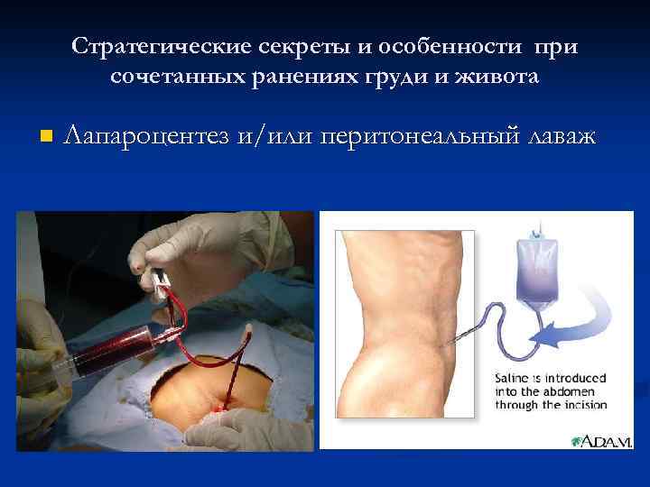 Стратегические секреты и особенности при сочетанных ранениях груди и живота n Лапароцентез и/или перитонеальный
