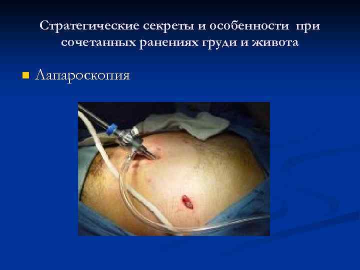 Стратегические секреты и особенности при сочетанных ранениях груди и живота n Лапароскопия 