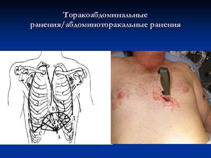 Торакоабдоминальные ранения/абдоминоторакальные ранения 