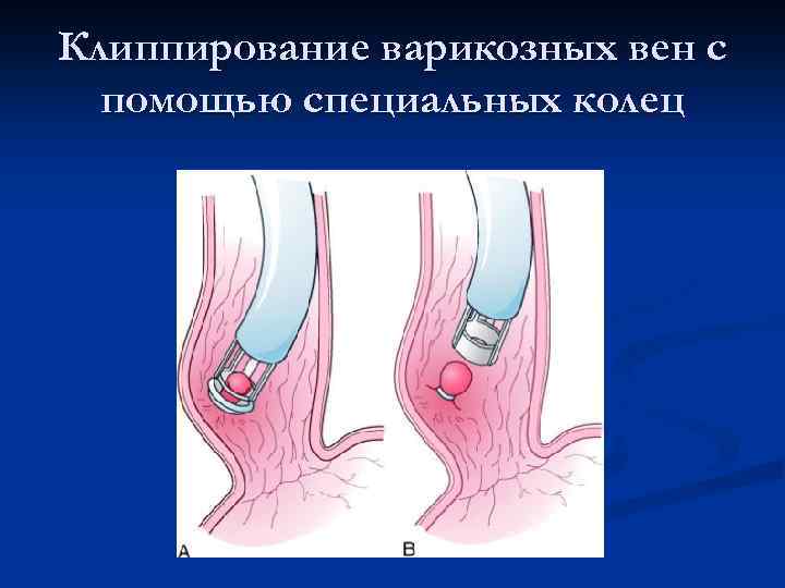 Клиппирование варикозных вен с помощью специальных колец 