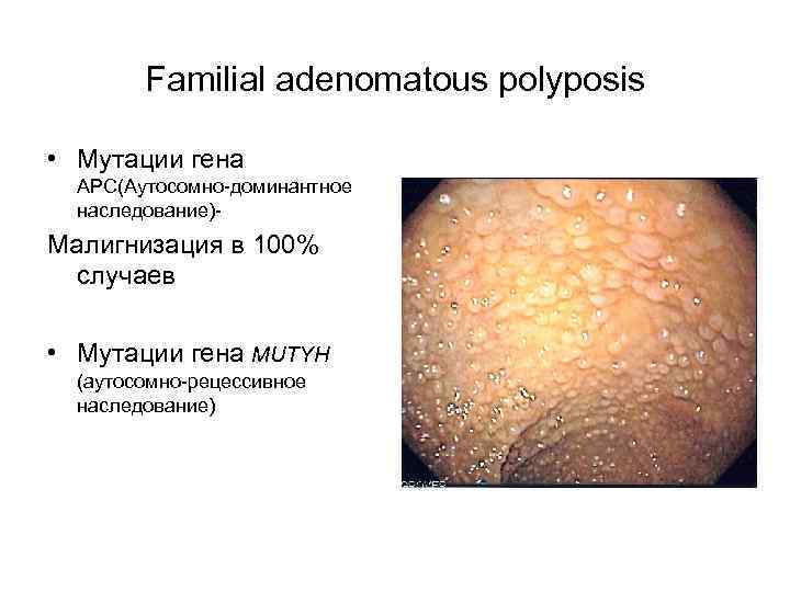 Familial adenomatous polyposis • Мутации гена АРС(Аутосомно-доминантное наследование)- Малигнизация в 100% случаев • Мутации