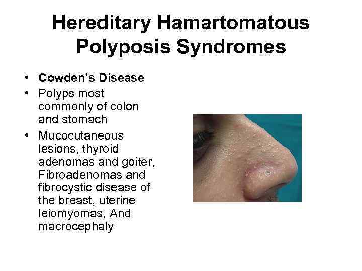 Hereditary Hamartomatous Polyposis Syndromes • Cowden’s Disease • Polyps most commonly of colon and