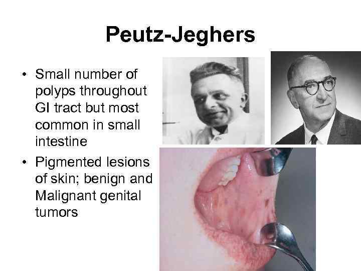 Peutz-Jeghers • Small number of polyps throughout GI tract but most common in small