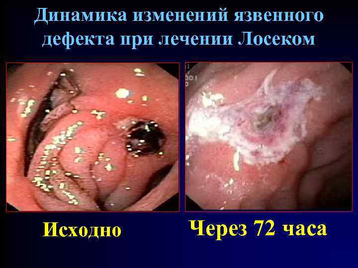 Динамика изменений язвенного дефекта при лечении Лосеком Исходно Через 72 часа 