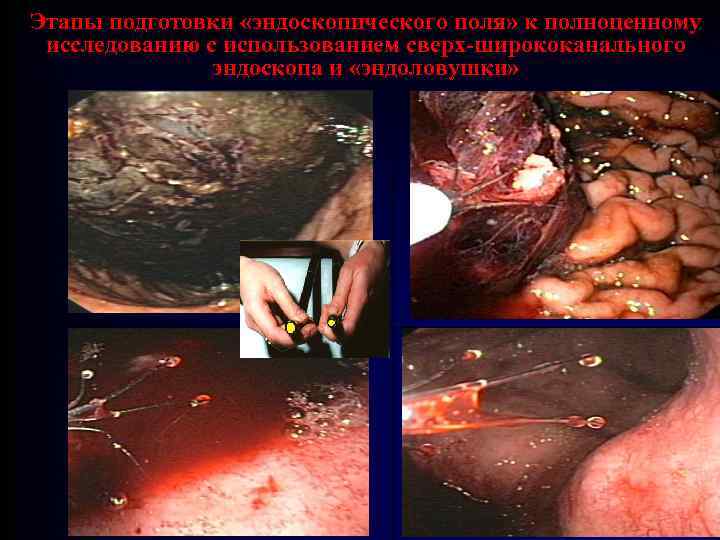 Этапы подготовки «эндоскопического поля» к полноценному исследованию с использованием сверх-ширококанального эндоскопа и «эндоловушки» 