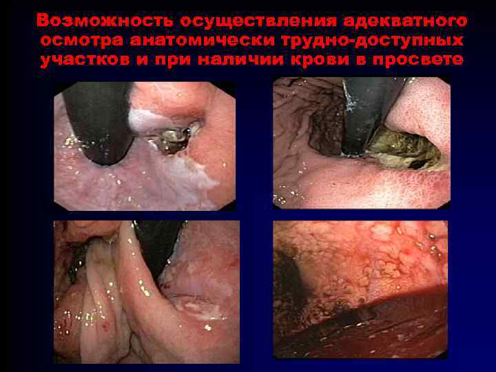 Возможность осуществления адекватного осмотра анатомически трудно-доступных участков и при наличии крови в просвете 