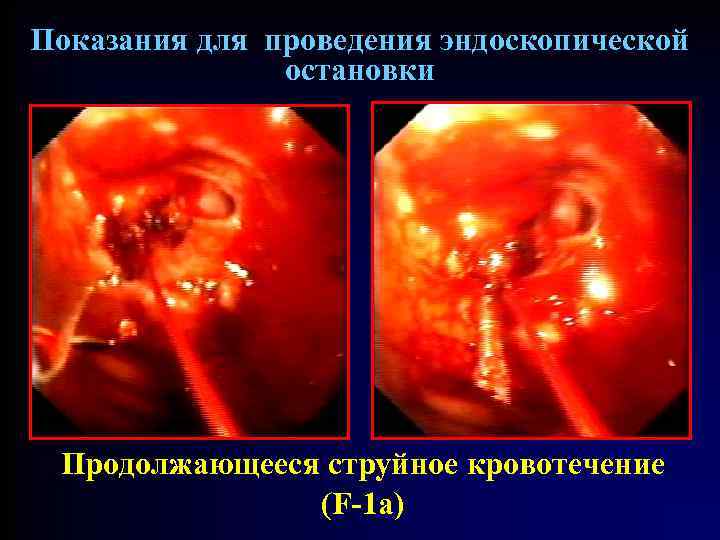 Показания для проведения эндоскопической остановки Продолжающееся струйное кровотечение (F-1 a) 
