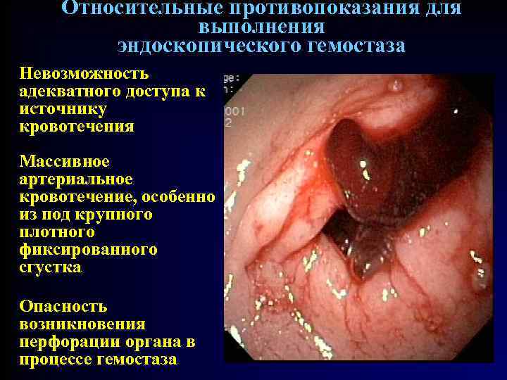 Относительные противопоказания для выполнения эндоскопического гемостаза Невозможность адекватного доступа к источнику кровотечения Массивное артериальное