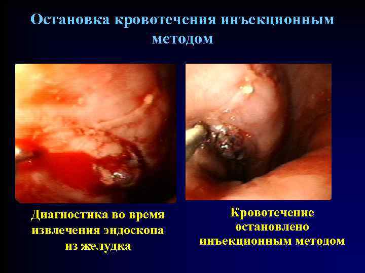 Остановка кровотечения инъекционным методом Диагностика во время извлечения эндоскопа из желудка Кровотечение остановлено инъекционным