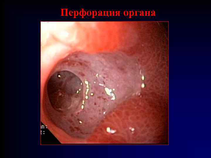 Перфорация органа 