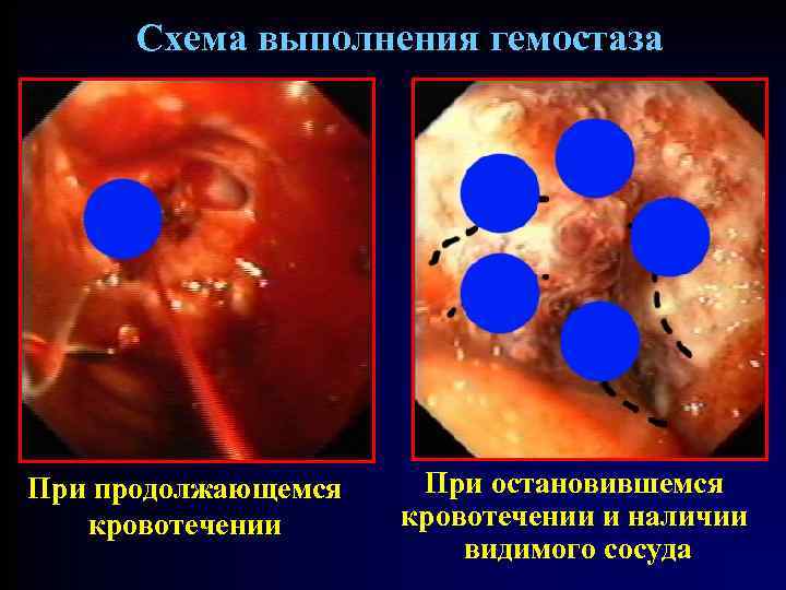 Схема выполнения гемостаза При продолжающемся кровотечении При остановившемся кровотечении и наличии видимого сосуда 